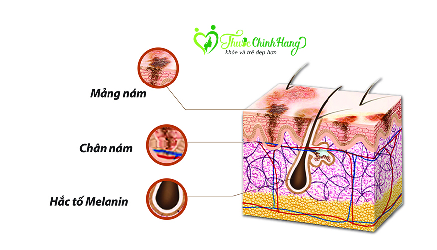 Kinh nghiệm trị nám chân sâu